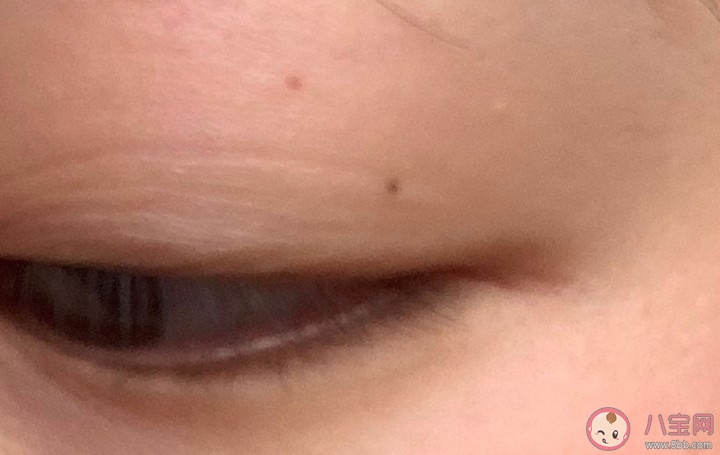 妖痣究竟長在什么位置 妖痣為什么很恐怖 妖痣究竟長在什么位置 妖痣為什么很恐怖