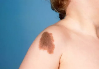 孕肚子受到撞擊會留下胎記嗎  寶寶有胎記懷孕時能檢查出來嗎