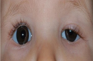 孩子大小眼正常嗎 孩子大小眼怎么辦