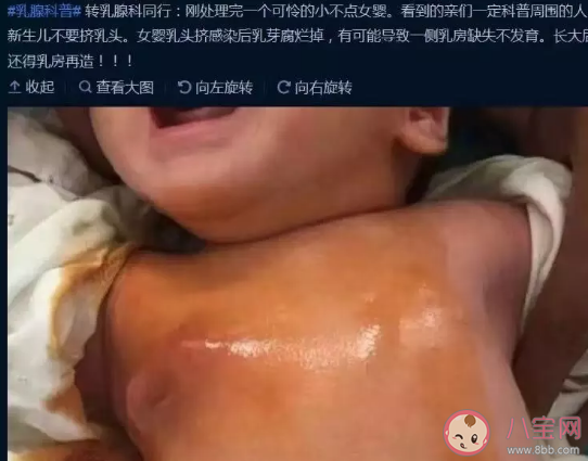 寶寶剛生出來就擠乳頭好嗎  新生女寶要不要擠乳頭