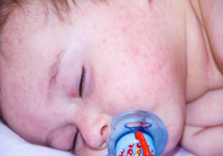 夏季孩子皮膚上起紅點是怎么回事 孩子身上起紅點是什么皮膚問題