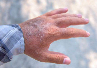 孕期手脫皮是不是血熱造成的 孕婦血熱引起的手脫皮如何解決