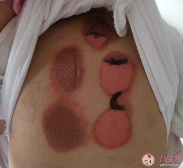 2020三伏貼幾月份開始貼 孩子貼三伏天皮膚過敏灼傷是怎么回事