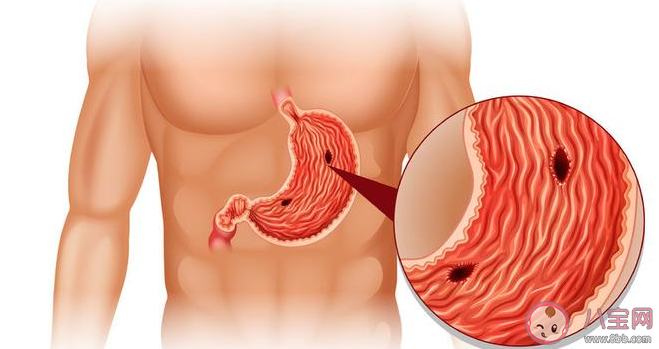 接吻會感染幽門螺旋桿菌嗎 怎么知道是不是有幽門螺旋桿菌