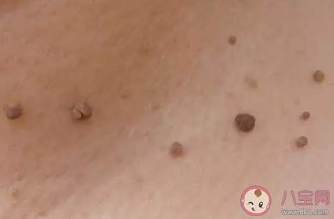 脖子是上有小肉粒是什么 脖子上長小肉疣怎么去除