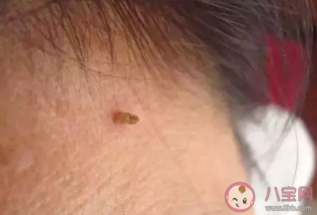 脖子是上有小肉粒是什么 脖子上長小肉疣怎么去除
