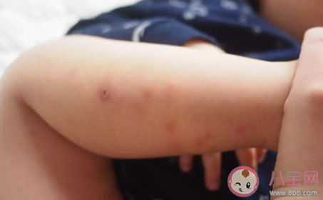 夏季寶寶皮膚瘙癢怎么回事 寶寶皮膚瘙癢怎么止癢