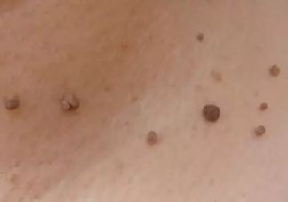 脖子是上有小肉粒是什么 脖子上長小肉疣怎么去除