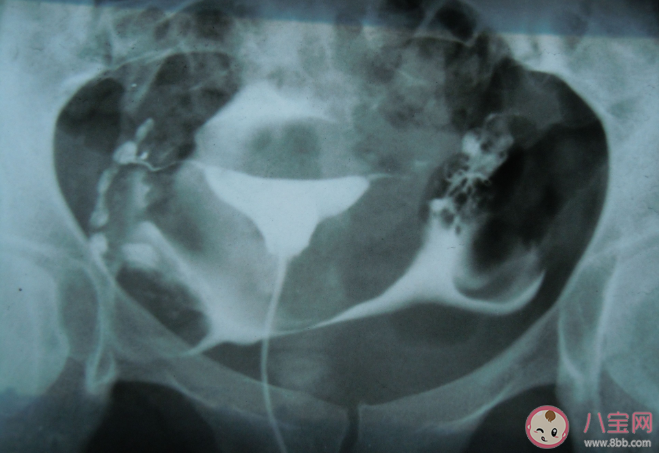 輸卵管粘連還能自然受孕嗎 輸卵管粘連怎么治療最有效