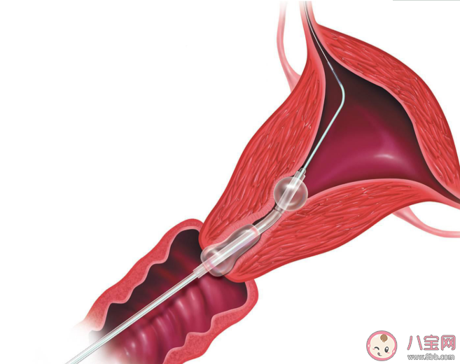 輸卵管粘連還能自然受孕嗎 輸卵管粘連怎么治療最有效