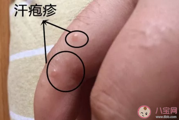 夏天手上愛長水泡是怎么回事 夏天手上長的小水泡是什么