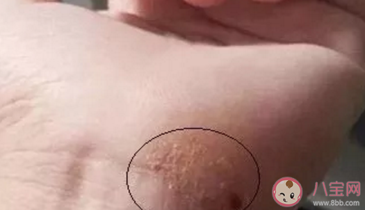 夏天手上愛長水泡是怎么回事 夏天手上長的小水泡是什么