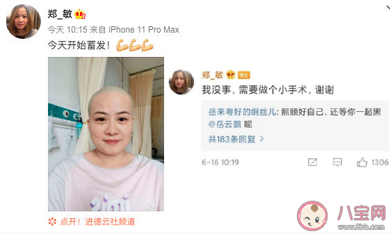 岳云鵬老婆為什么剃光頭 剃光頭是得了什么病