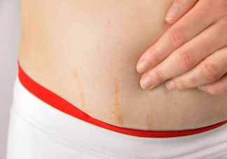 孕期肚子小不會長妊娠紋嗎 妊娠紋和肚子大小有關嗎