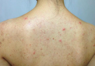 后背長痘怎么消除 后背長痘消除方法