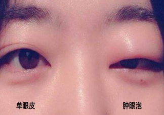 哪些人不能做去腫眼泡手術呢 去腫眼泡手術有副作用嗎。