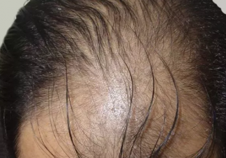 男性禿頭與性生活過度有關(guān)系嗎 男性禿頭是什么原因造成的