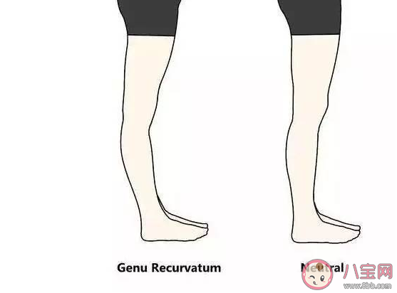 膝蓋不直膝蓋超伸怎么改正 不胖腿粗怎么辦