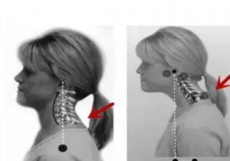 富貴包怎么形成的有什么危害 如何快速消除富貴包