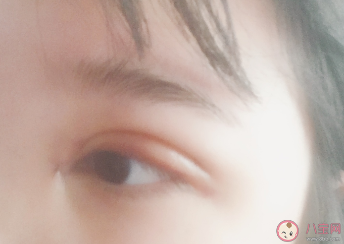 開眼角可以改善哪些眼部問題 開眼角有什么好處