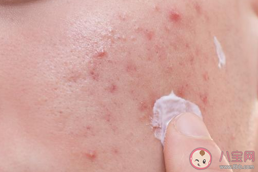 想改善痘印可以涂什么藥 臉上有痘印怎么辦