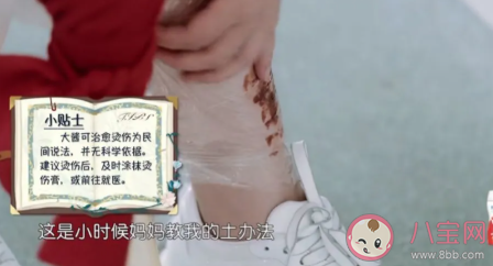 被燙傷怎么緊急處理 燙傷的正確處理辦法