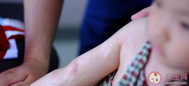 暑假最常見的兒童意外傷害 暑假意外急救指南