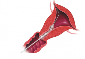 輸卵管造影后多長時間不能性生活 輸卵管造影多久后可以同房