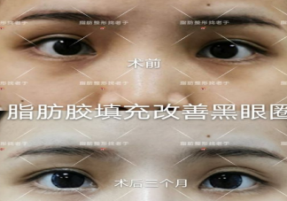 黑眼圈很嚴重的搞笑說說 有黑眼圈的心情說說