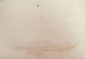 剖腹產(chǎn)刀口癢是快愈合了嗎 剖腹產(chǎn)傷口癢怎么緩解