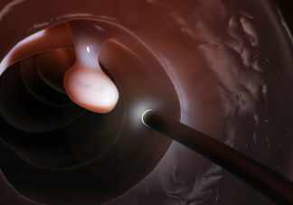 宮頸息肉會影響女性懷孕嗎 日常如何預防宮頸息肉