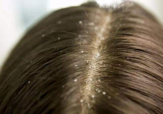 為什么會產生頭皮屑 如何有效清理頭皮屑