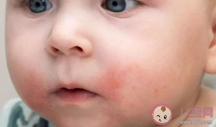 男孩吃葡萄過敏怎么回事 孩子過敏了怎么處理