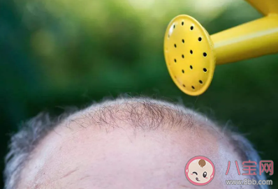 溢脂性脫發(fā)怎么治療 日常生活怎么預(yù)防