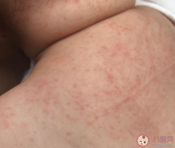 孩子洗澡水里滴去痱水可以預防長痱子嗎 洗澡水里滴去痱子水有用嗎