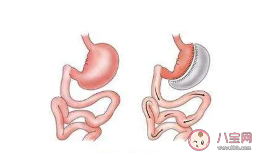 患了糖尿病進行切胃手術有用嗎 切胃手術會不會導致身體后遺癥 患了糖尿病進行切胃手術有用嗎 切胃手術會不會導致身體后遺癥