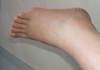 孕期腿腳水腫怎么緩解不適 緩解腿腳水腫的方法