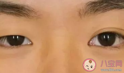 如何看待高考生扎堆割雙眼皮 割雙眼皮真能變漂亮嗎