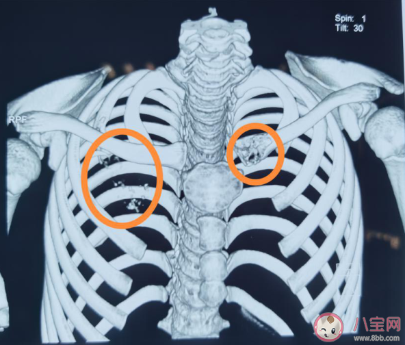 12歲男孩確診肺癌晚期是怎么回事 小小年紀(jì)為什么會得肺癌