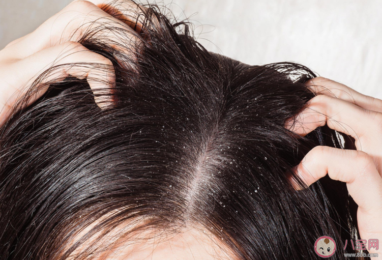 頭皮癢頭皮屑多有可能傳染嗎 支付寶螞蟻莊園9月23日今日答案最新 頭皮癢頭皮屑多有可能傳染嗎 支付寶螞蟻莊園9月23日今日答案最新