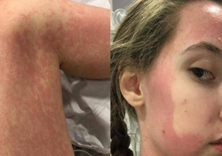 英國女子對所有食物過敏什么原因 大細胞活化綜合征能治好嗎