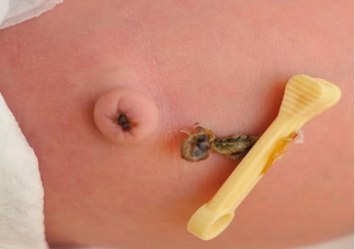 能給孩子貼肚臍貼嗎 臍貼能治療孩子腹瀉嗎