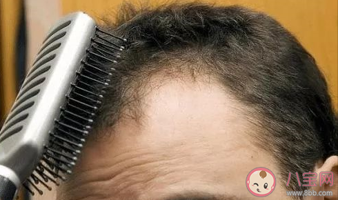 植發群體中90后過半是真的嗎 年輕人脫發怎么調理 植發群體中90后過半是真的嗎 年輕人脫發怎么調理