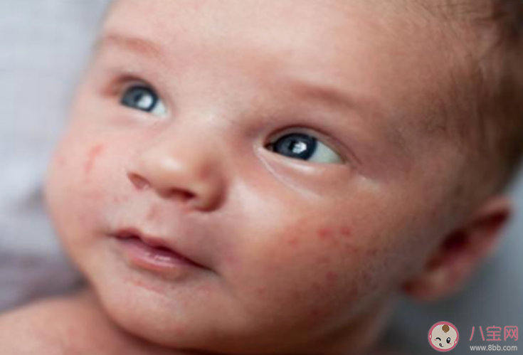 剖腹產的孩子更容易哮喘過敏嗎 如何預防過敏引發的哮喘