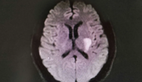 針刺腦卒中患者放血減輕病情靠譜嗎 螞蟻莊園12月2日答案