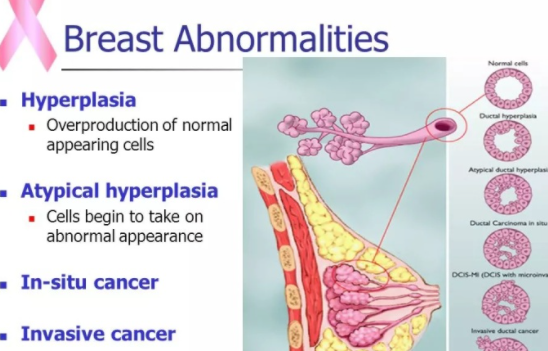 體檢出現增生結節等異常要緊嗎 查出結節增生怎么辦 體檢出現增生結節等異常要緊嗎 查出結節增生怎么辦