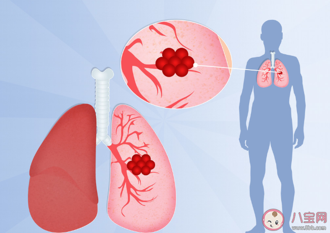 肺結核體檢結果將納入學生健康檔案 ?為什么要納入學生健康檔案