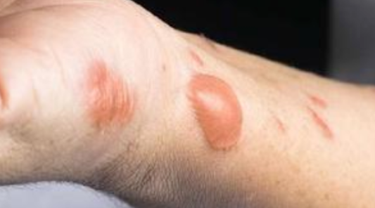 被暖寶寶燙出水泡怎么辦 不小心被低溫燙傷怎么辦