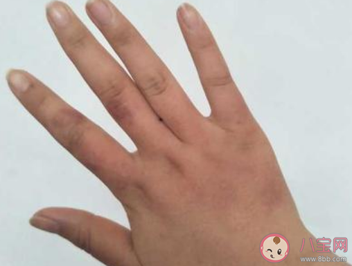 用醋能不能治療凍瘡 臉部凍瘡是怎么回事