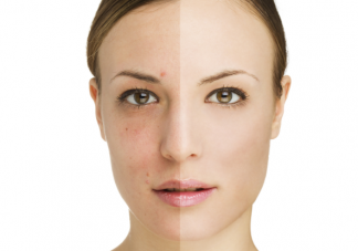 臉上長黃褐斑是皮膚早衰了嗎 黃褐斑的正規治療方法是什么